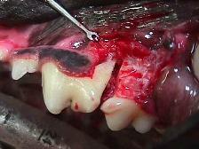 Exposure of Root Of Damaged Tooth Before Repair